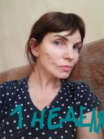 Подтяжка лица нитями Аптос фото