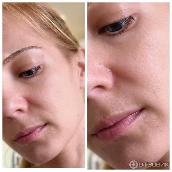 результат применения сыворотки - филлера Vichy Liftactive Supreme